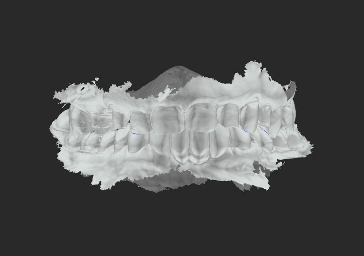 Bite-Finder Sonrası - Doğru Kapanış