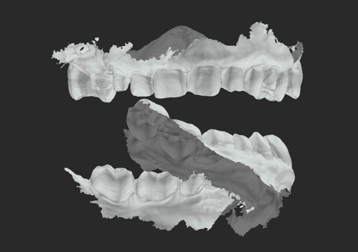 Bite-Finder Öncesi - Yanlış Kapanış